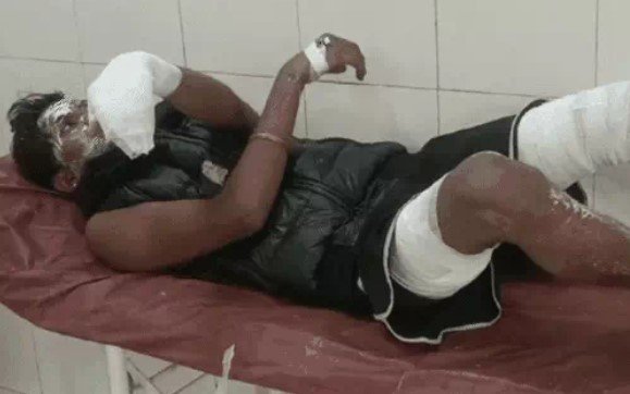 Worker burnt in fire while coating Bahadurgarh fan with thinner