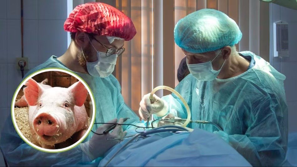 Death of a person who got pig kidney transplant